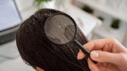 ঘরোয়া সমাধান জেনে নিন 'তেলতেলে চুল? 