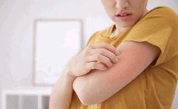 ''গরমে ঘামাচি থেকে বাঁচার সহজ উপায়''